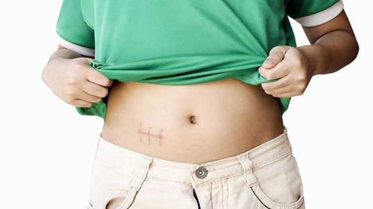 Symptoms of appendicitis in children