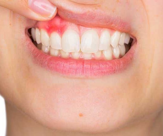 Do your gums bleed usually? These remedies solve it It can appear as a punctual pain associated with a wound or trauma