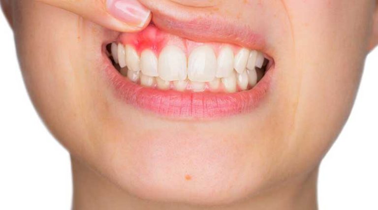 Do your gums bleed usually? These remedies solve it