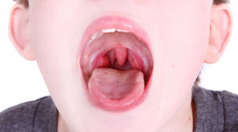 In which cases should the tonsils be removed?