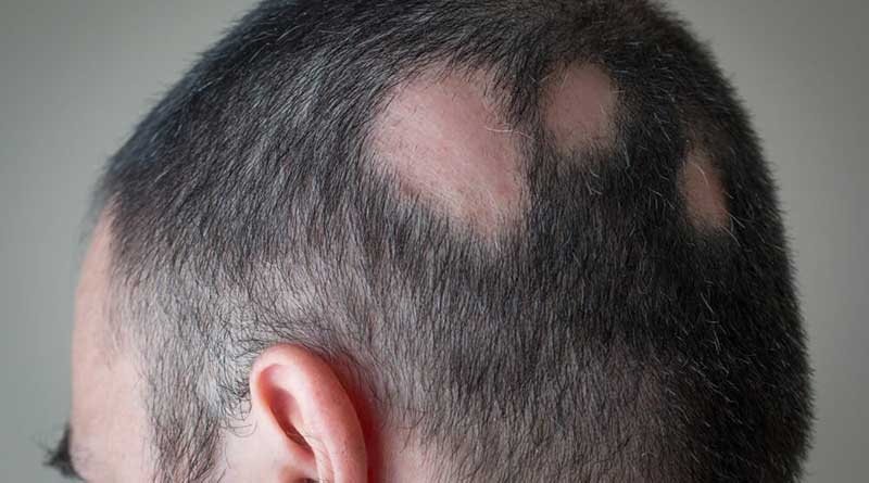 Symptom Trichotillomania