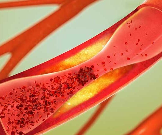 How to take care of arterial health: 6 healthy habits How to take care of arterial health: 6 healthy habits