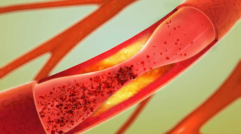 How to take care of arterial health: 6 healthy habits