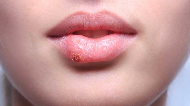 The treatment of cold sores