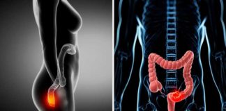 How is the removal of a rectal foreign body? How is the removal of a rectal foreign body?