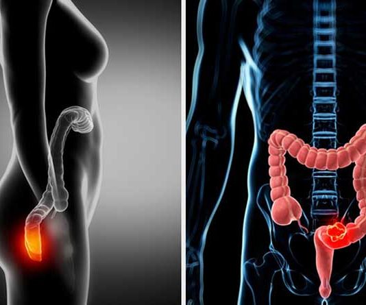 How is the removal of a rectal foreign body? How is the removal of a rectal foreign body?