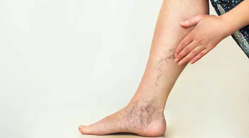 How to prevent varicose veins