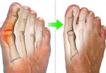 Bunions: how to prevent them and what is their treatment Bunions: how to prevent them and what is their treatment
