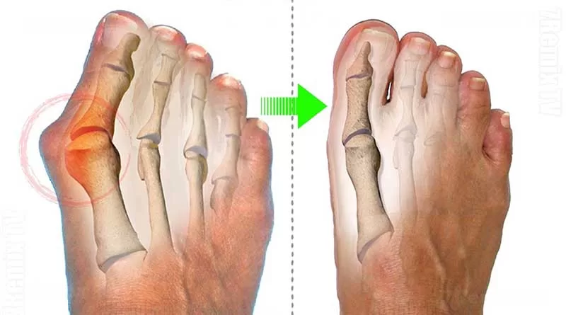 Bunions: how to prevent them and what is their treatment